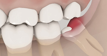 Teilretinierter Weisheitszahn