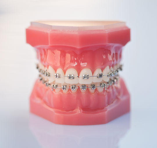 3D Zahnmodell mit Brackets